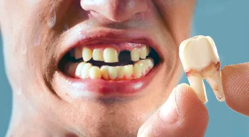 Что делать, если выбили зуб: видео - «Стоматология»