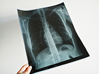 Биологи установили, что позволяет развиваться туберкулезу - «Здоровая жизнь»