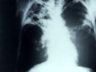 Эксперты рассказали, в каких странах выше риск заразиться стойким туберкулезом - «Здоровая жизнь»