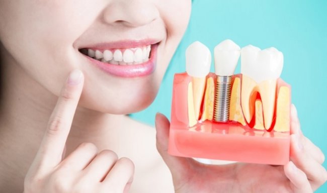 7 причин не откладывать имплантацию зубов - «Здоровая жизнь»