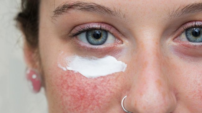 Почему краснеет кожа лица: 8 неочевидных причин - «Дерматология»