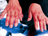 Повреждения, вызванные обморожением, возможно излечить, используя средство в форме спрея - «Здоровая жизнь»