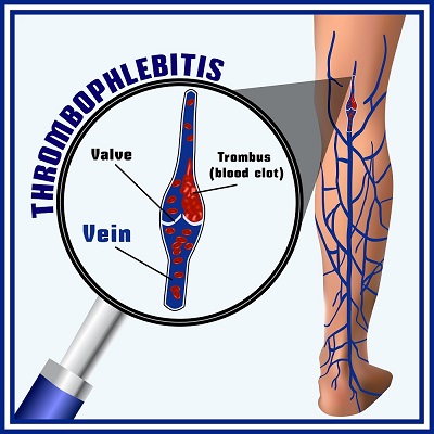 Варикоз: одних таблеток мало - «Здоровая жизнь»