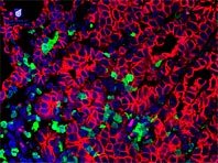 Обнаружена новая мишень для терапии самых агрессивных опухолей - «Здоровая жизнь»