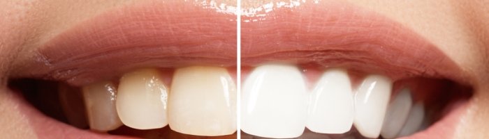 Отбеливание зубов - «Гинекология»