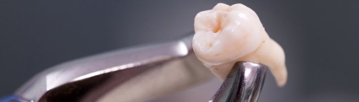 Что делать после удаления зуба? Памятка чтобы не было осложнений - «Инфекционные заболевания»