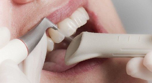 5 причин возникновения зубного камня и способы профилактики - «Стоматология»