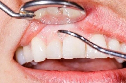 Названы 7 распространенных привычек при чистке зубов, которые разрушают эмаль и десны - «Стоматология»