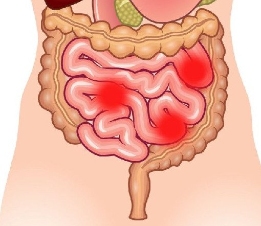Несколько необычных признаков ухудшившегося состояния кишечника - «Гастроэнтерология»