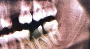 Современные стоматологи приходят в ужас: чем и как лечили зубы в прошлом - «Стоматология»