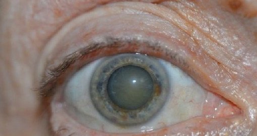 Удаление катаракты снижает смертность у женщин - «Хирургия»