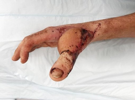 Хирурги пересадили пациенту палец ноги на руку - «Хирургия»