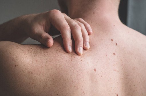 Дерматологи назвали вид рака кожи, который опаснее меланомы - «Онкология»