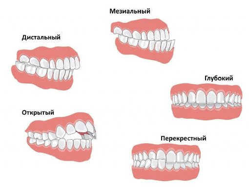 Прикус: что это, виды, как определить - «Стоматология»