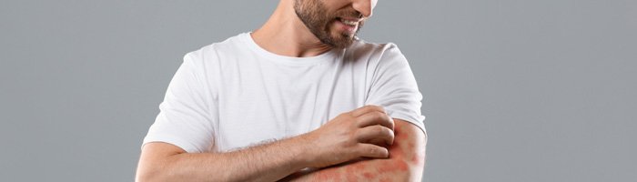 Более 60% пациентов с хронической крапивницей в России не могут контролировать симптомы, несмотря на лечение - «Кардиология»