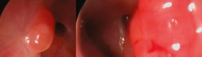 Оценка анатомической и функциональной состоятельности дакриостомы в послеоперационном периоде - «Аллергология»