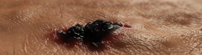 Российский биоаналог пембролизумаба показал эффективность в реальной клинической практике - «Новости Медицины»