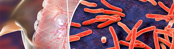 Лечение лекарственно устойчивого туберкулеза в России удалось сократить до полугода - «Аллергология»