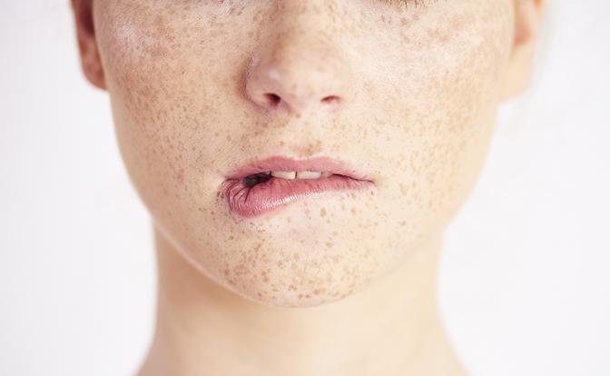 Что нужно знать о лазерной эпиляции при гиперпигментации и склонности к рубцеванию - Свободная Пресса - Медицина и здоровье. Красота и уход. Лазерная эпиляция. Новости здоровья - «Новости Медицины»