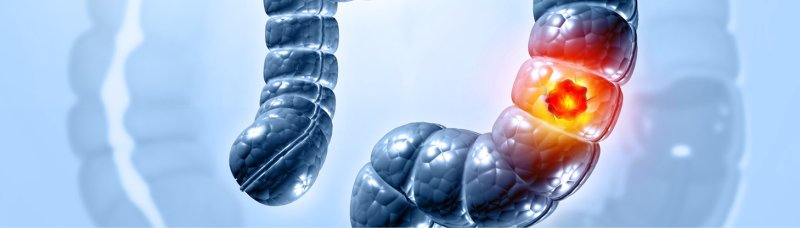 Холерный токсин значительно уменьшает рост опухоли при колоректальном раке - «Инфекционные заболевания»