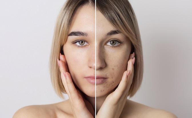 Почему стресс и нарушение сна могут вызывать акне - Свободная Пресса - Красота и уход. Лечение акне. Воспаления кожи. Методы лечения акне. Новости медицины. Новости России и мира - «Новости Медицины»