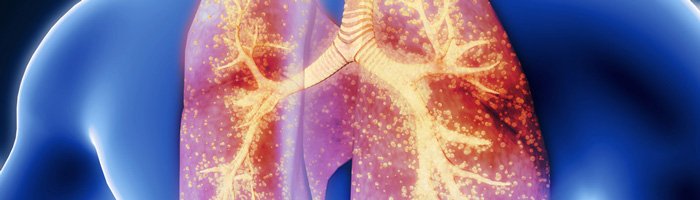 Только 9% взрослых привиты от пневмококка: врачи призывают усилить профилактику пневмонии - «Инфекционные заболевания»