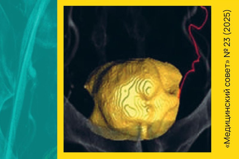 Клинический случай суперселективной катетеризации простатических артерий при рентгенэндоваскулярном лечении доброкачественной гиперплазии предстательной железы - «Гинекология»